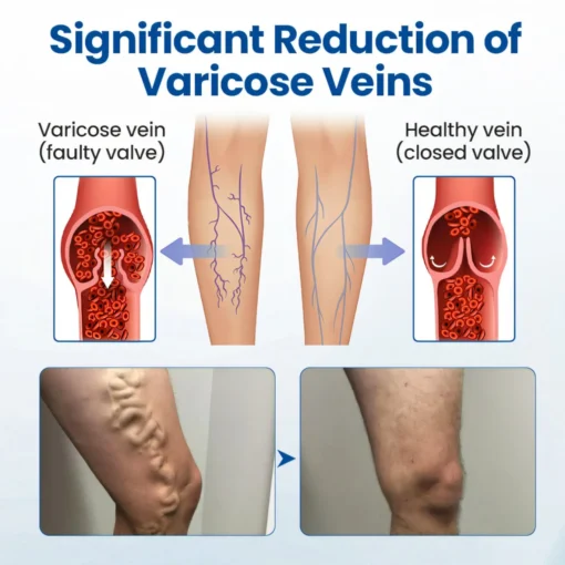 Cvreoz® Varicose Veins Patch