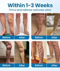 Cvreoz® VeinGuard Herbal Spray