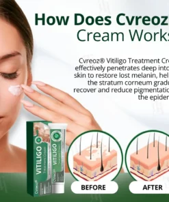 Cvreoz® Vitiligo Treatment Cream