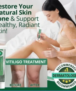 Cvreoz® Vitiligo Treatment Cream