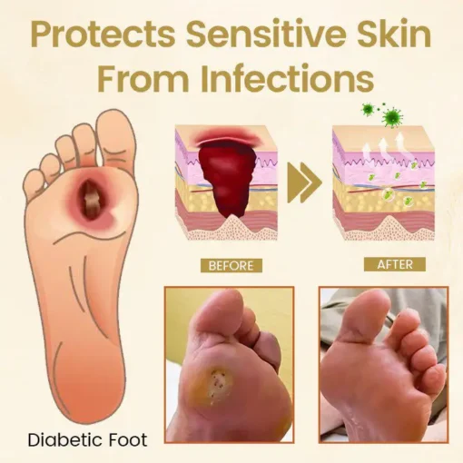 CVREOZ® Bee Venom Diabetic Foot Healing Spray