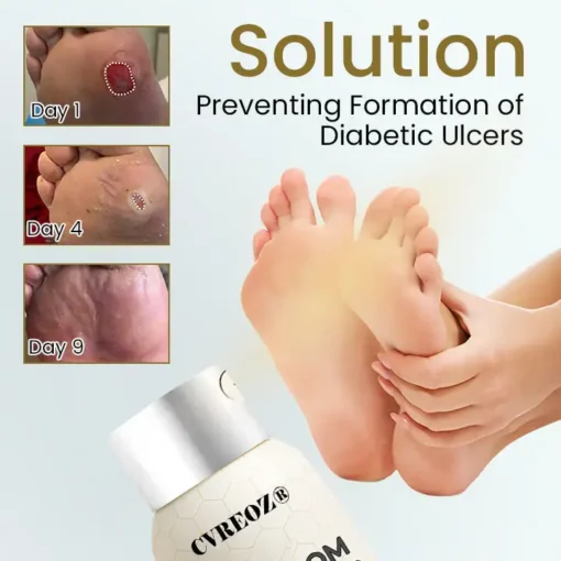 CVREOZ® Bee Venom Diabetic Foot Healing Spray