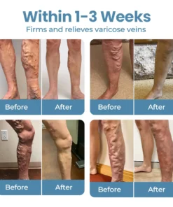 CVREOZ® Herbal Relief Varicose Vein Spray