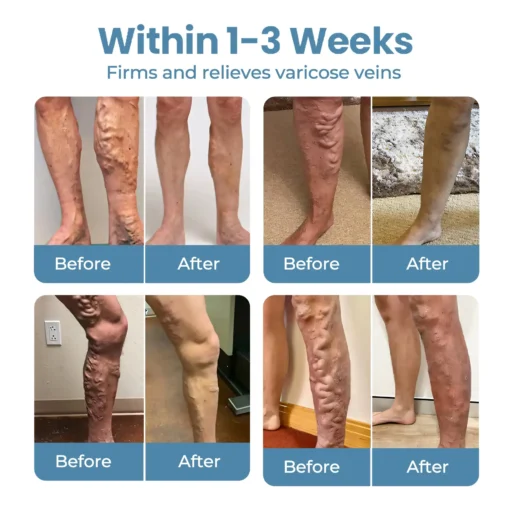 CVREOZ® Herbal Relief Varicose Vein Spray