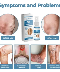 CVREOZ® Herbal Relief Varicose Vein Spray