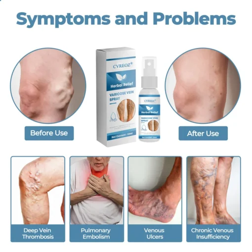 CVREOZ® Herbal Relief Varicose Vein Spray