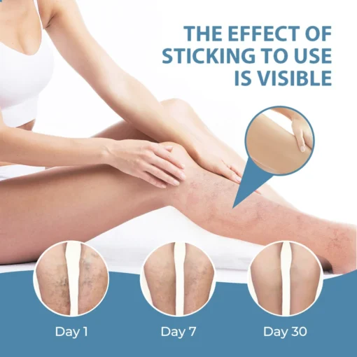 CVREOZ® Herbal Relief Varicose Vein Spray