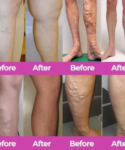 CVREOZ® VeinFlow Advanced Varicose Vein Patch