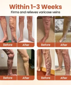 CVREOZ® VeinTarget Nanotech Microneedle Patch