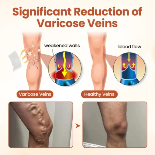 CVREOZ® VeinTarget Nanotech Microneedle Patch