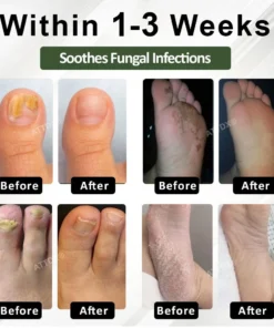 Cvreoz® 7 days Nail Fungus Renewal Herbal Spray