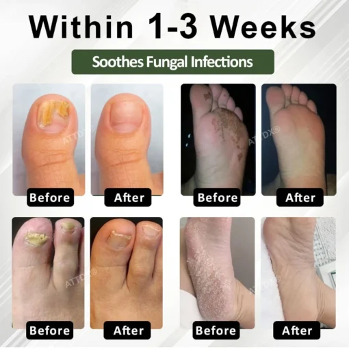 Cvreoz® 7 days Nail Fungus Renewal Herbal Spray