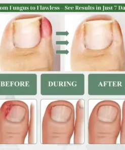 Cvreoz® 7 days Nail Fungus Renewal Herbal Spray