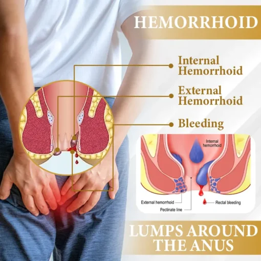 Cvreoz® Apis Venom Hemorrhoid Cooling Spray