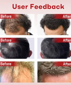 Cvreoz® Hair Regrowth System