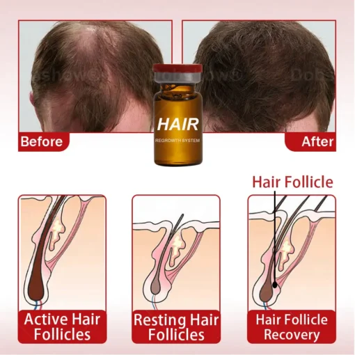 Cvreoz® Hair Regrowth System