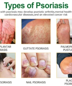 Cvreoz® Knotaway Psoriasis Cream