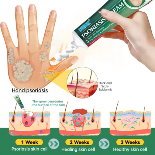 Cvreoz® Knotaway Psoriasis Cream