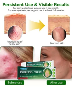 Cvreoz® Knotaway Psoriasis Cream