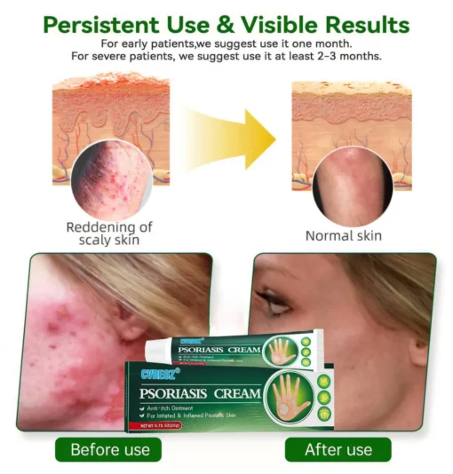 Cvreoz® Knotaway Psoriasis Cream