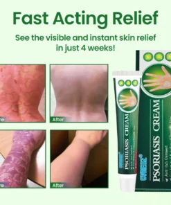 Cvreoz® Knotaway Psoriasis Cream