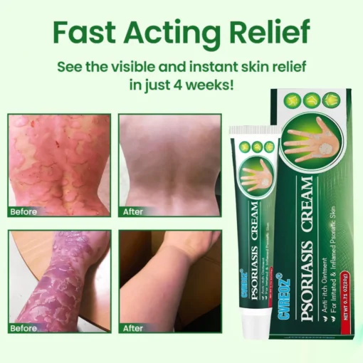 Cvreoz® Knotaway Psoriasis Cream