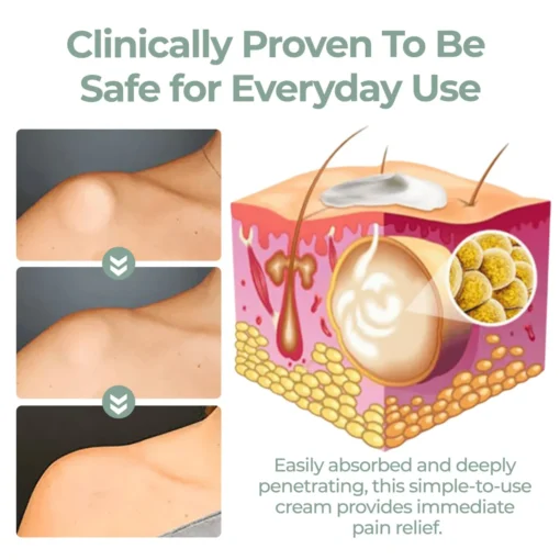Cvreoz® Lipoma Herbal Relief Cream