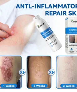 Cvreoz® Magnesium Herbal Psoriasis Spray