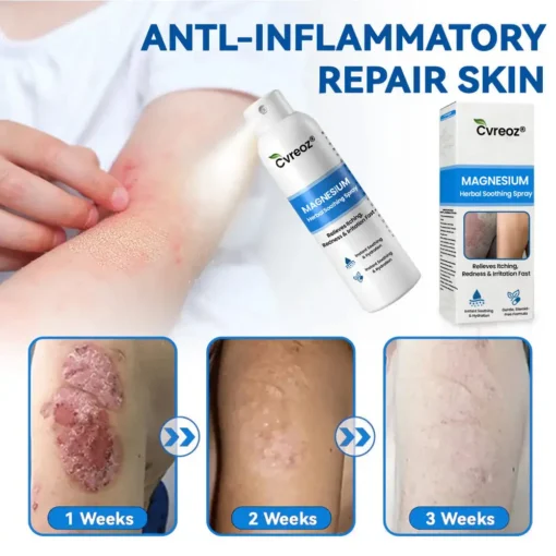 Cvreoz® Magnesium Herbal Psoriasis Spray
