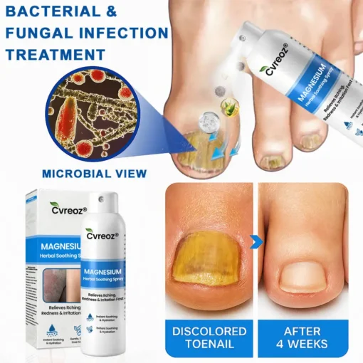 Cvreoz® Magnesium Herbal Psoriasis Spray