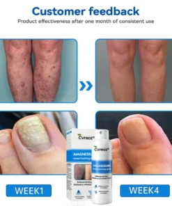 Cvreoz® Magnesium Herbal Psoriasis Spray