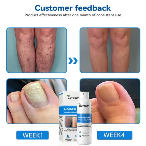 Cvreoz® Magnesium Herbal Psoriasis Spray