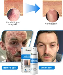 Cvreoz® Magnesium Herbal Psoriasis Spray