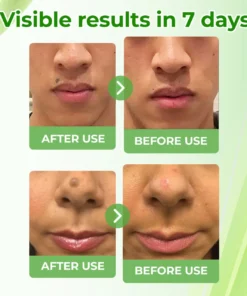 Cvreoz® Natural Spot and Mole removal cream