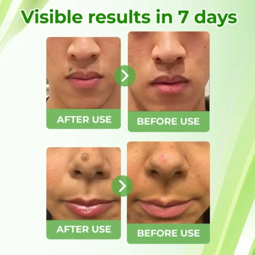 Cvreoz® Natural Spot and Mole removal cream
