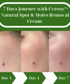 Cvreoz® Natural Spot and Mole removal cream