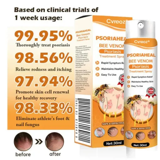 Cvreoz® PsoriaHeal Bee Venom Psoriasis Treatment Spray