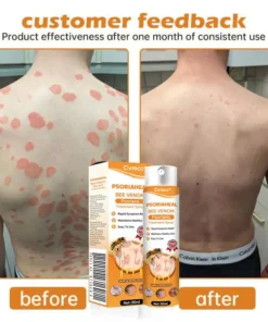 Cvreoz® PsoriaHeal Bee Venom Psoriasis Treatment Spray