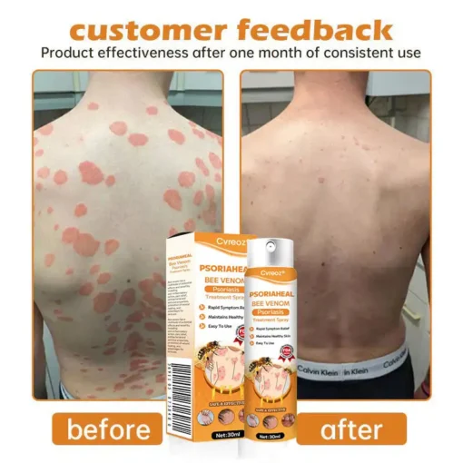 Cvreoz® PsoriaHeal Bee Venom Psoriasis Treatment Spray