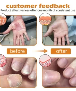 Cvreoz® PsoriaHeal Bee Venom Psoriasis Treatment Spray
