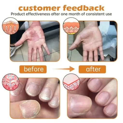 Cvreoz® PsoriaHeal Bee Venom Psoriasis Treatment Spray