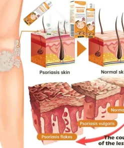 Cvreoz® PsoriaHeal Bee Venom Psoriasis Treatment Spray