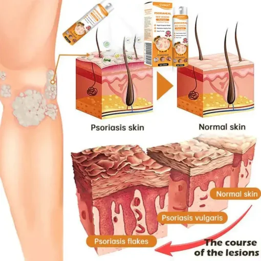 Cvreoz® PsoriaHeal Bee Venom Psoriasis Treatment Spray