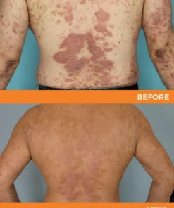 Cvreoz® Psoriasis Bee Venom Care Spray
