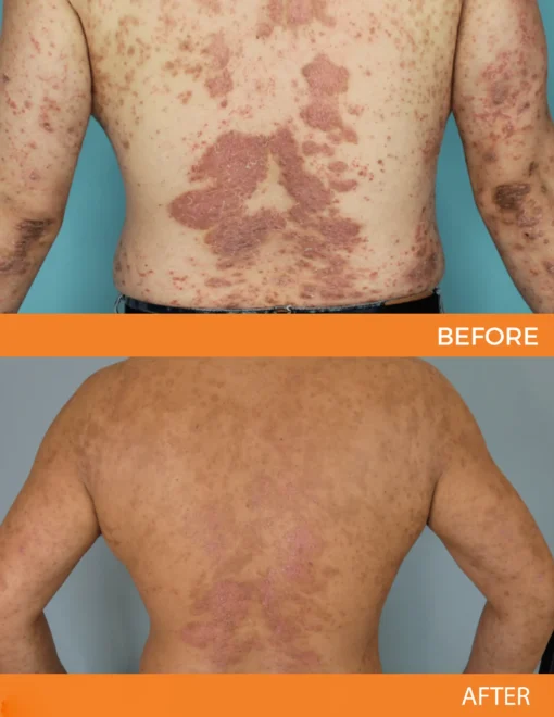 Cvreoz® Psoriasis Bee Venom Care Spray