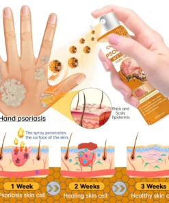 Cvreoz® Psoriasis Bee Venom Care Spray