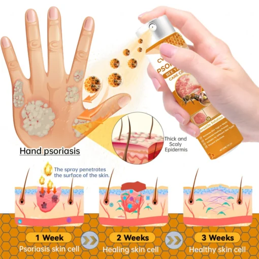 Cvreoz® Psoriasis Bee Venom Care Spray