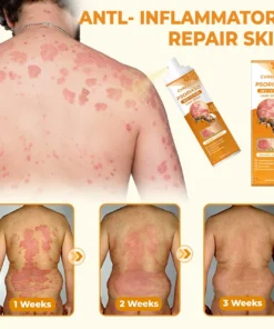 Cvreoz® Psoriasis Bee Venom Care Spray