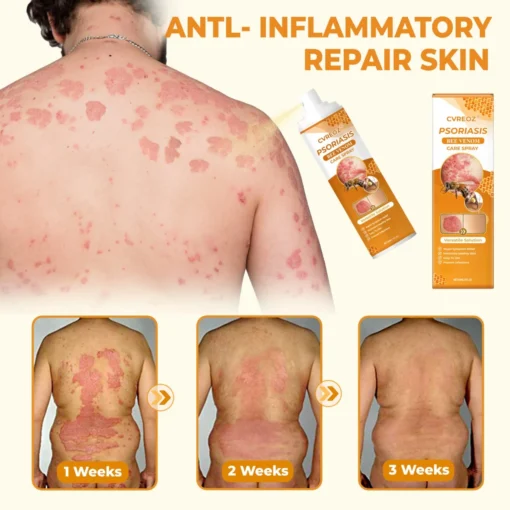 Cvreoz® Psoriasis Bee Venom Care Spray