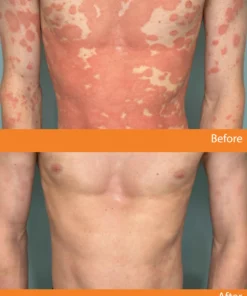 Cvreoz® Psoriasis Bee Venom Care Spray